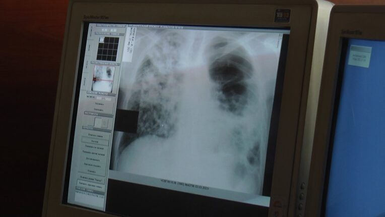 На Прикарпатті зростає рівень захворюваності на туберкульоз серед дітей
